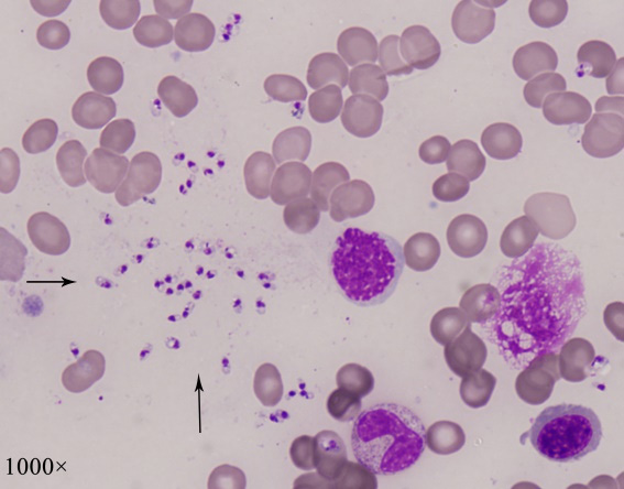 患者骨髓涂片可见大量利什曼原虫无鞭毛体